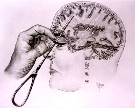 A drawing from Dr. Walter Freeman’s book showing his lobotomy procedure